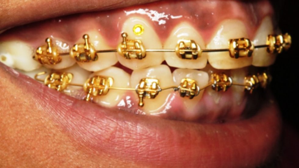 gold-plated-braces-1170x754
